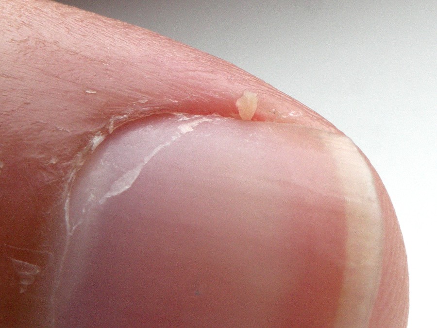 Droge nagelriemen? Oma weet raad!