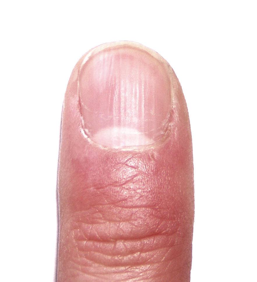Psoriasisnagels? Oma weet raad met deze tips voor sterke, gezonde nagels